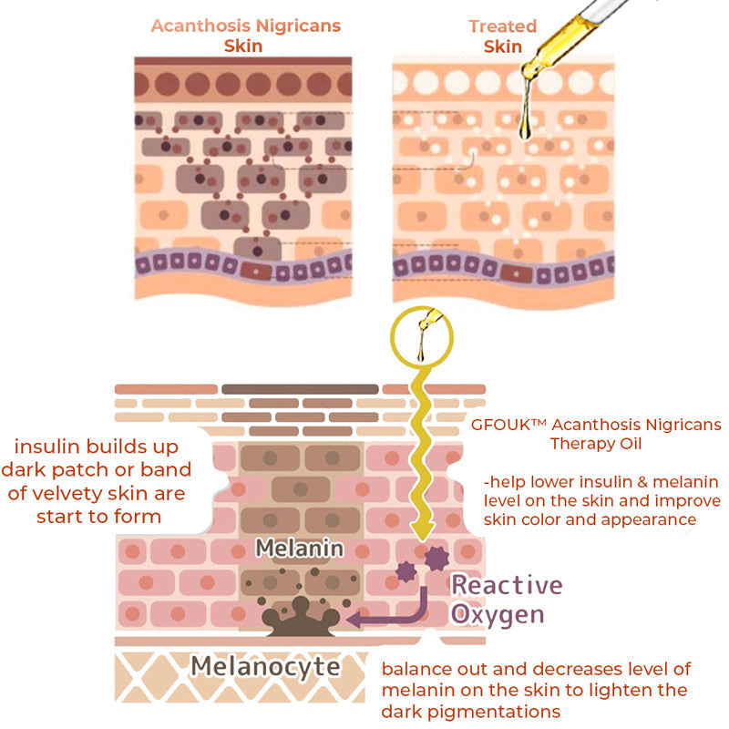 Acanthosis Nigricans Therapie Öl