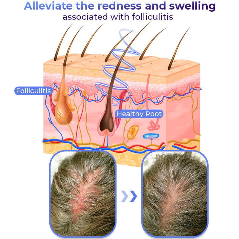 Anti Follikulitis Therapieöl